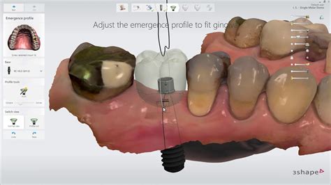 3shape Implant Studio 2019 Screw Retained Crown Workflow Pl Youtube