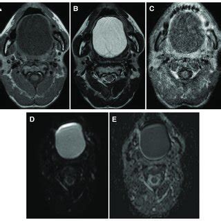 MRI Findings A Low Signal At T1 B High Signal At T2 C Contrast