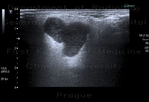 Radiology Case Pleomorphic Adenoma Parotid Gland