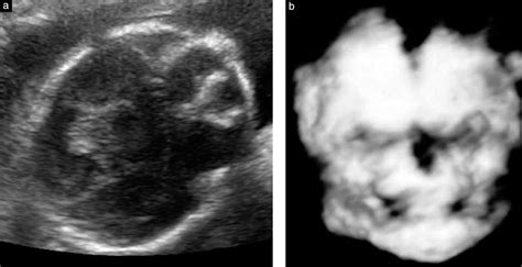 Antenatal Diagnosis Of Anophthalmia By Threedimensional Ultrasound A