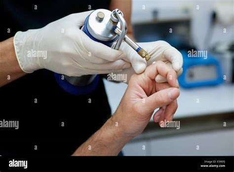 Dermatologist Treating A Wart With Liquid Nitrogen Stock Photo Alamy