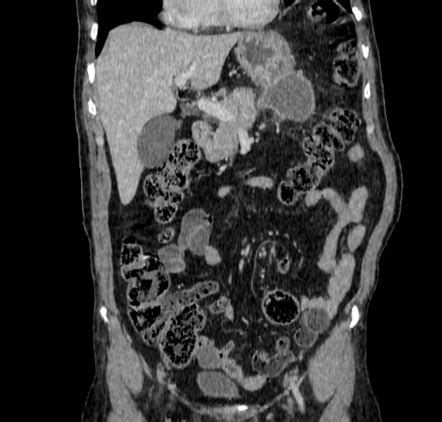 Perforated Duodenal Ulcer With Formation Of Abscesses Radiology Case