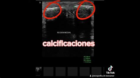 Enfermedad De Peyronie Por Ecografía Youtube