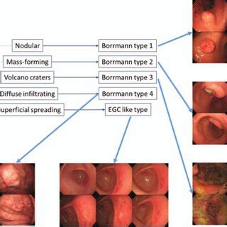 Classification And Examples Of Endoscopic Morphologic Findings