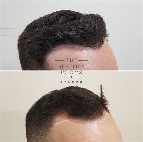 Does Fue Hair Transplant Surgery Leave Scars