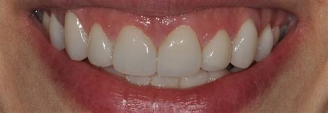 Cosmetic Dentist Chevy Chase Crowns Veneers Implants