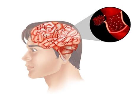 Pituitary Adenoma: Symptoms, Diagnosis, And Treatments