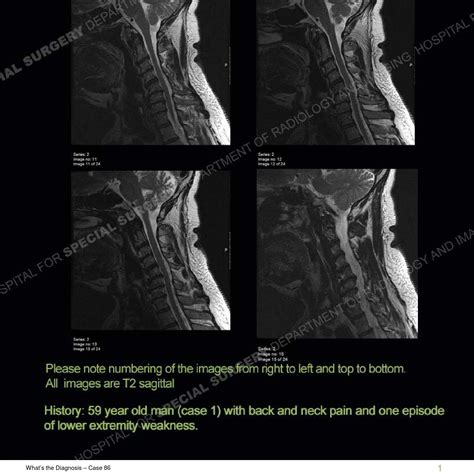 Hss Whats The Diagnosis Case 86 By Hospital For Special Surgery Issuu