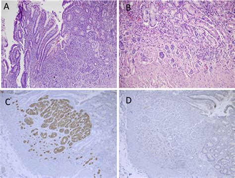 Neuroendocrine Cell Hyperplasia A A Large Nest Of Neuroendocrine