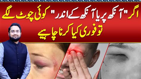 Eye Injury Hune Ke Bad Forun Kia Karna Chahe Precautions For Eye Injury Or Eye Trauma Eye