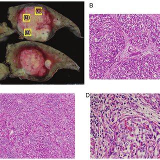 Macroscopic Findings Of Resected Liver Tumor A The Axial Cut Surface