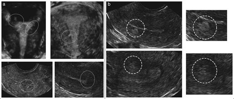 Terms Definitions And Measurements To Describe Sonographic Features Of