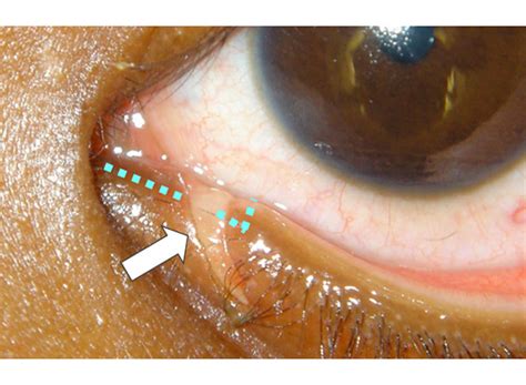 Canalicular Injury The Dh Verity Eye Practice