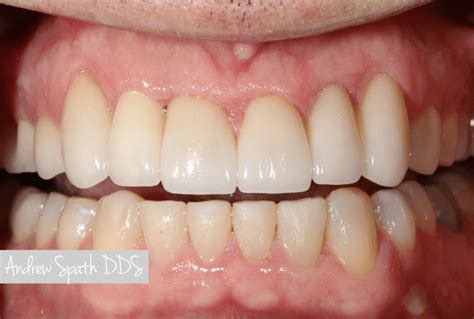 Dental Implant Veneers Crown Lengthening And Bonding General