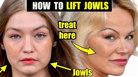 How To Lift And Tighten The Jowls With Sculptra Fda Proven To Tighten