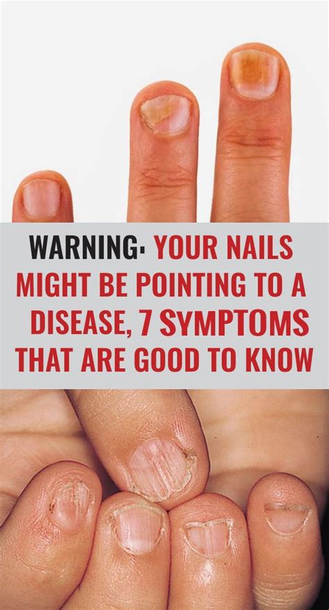 7 Common Nail Conditions Linked To Serious Diseases That You Should Not Ignore Women Health