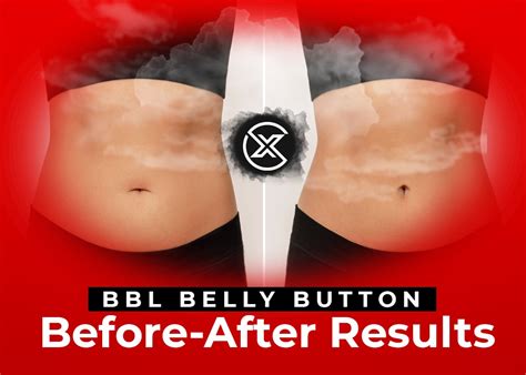 Bbl Belly Button Before After Results