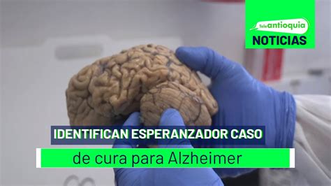 Identifican Esperanzador Caso De Cura Para Alzheimer Teleantioquia