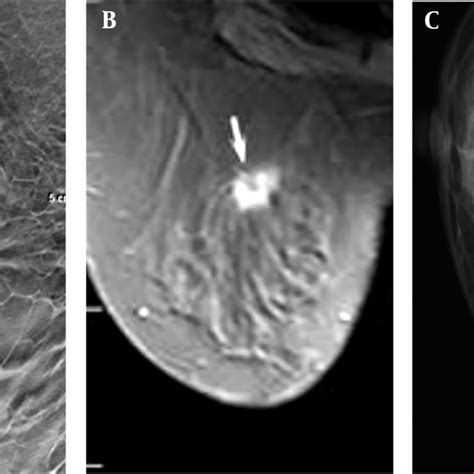 The Imaging Results Of A 45 Year Old Female Patient With A Dense Download Scientific Diagram