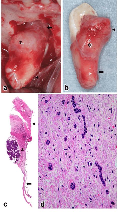 Adenomatoid Odontogenic Tumor Gross