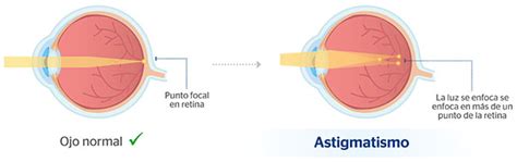 Astigmatismo O Que Causas Sintomas Como Corrigir Atelier Yuwa