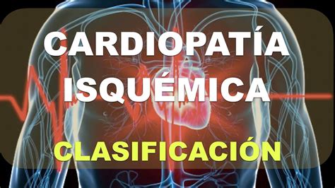 Cardiopat A Isqu Mica Cr Nica Vs Aguda Fisiopatolog A Youtube