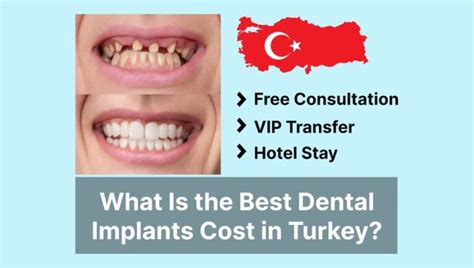 Best Dental Implants In Turkey Cost And Package Deals