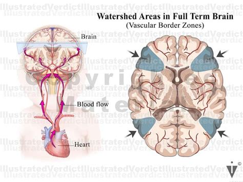 Stock Baby: Brain Hypoxia / Watershed — Illustrated Verdict