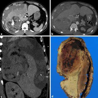 A Contrast Enhanced Ct Revealed A Hepatic Aml With Foci Of Low Density