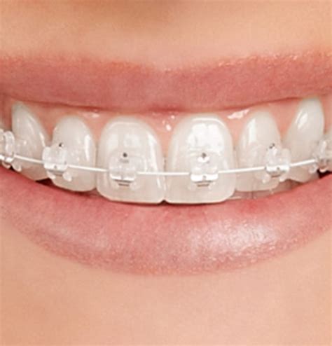 Orthodontics At Klinika Dental Clinic In Dubai Invisalign Clear