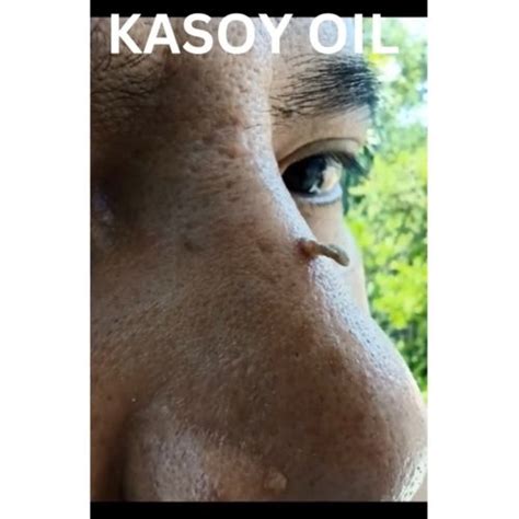 Kasoy Oil Ml Pure Organic Original And Authentic Kasoy Oil