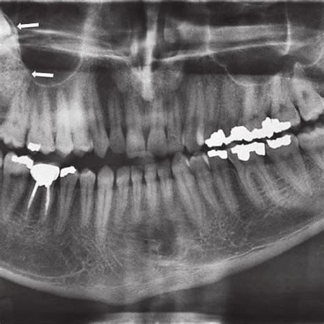 A Panoramic View Shows A Unicystic Ameloblastoma Presenting As A