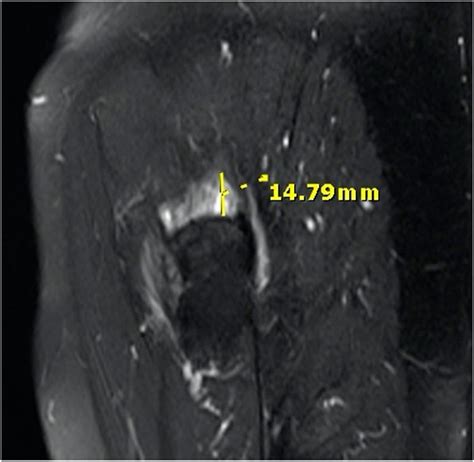 Three Grade Magnetic Resonance ImagingBased Gluteus Medius And Or