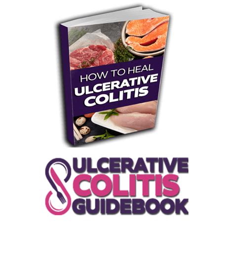 Guides Ulcerative Colitis