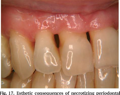 Acute Periodontal Lesions Semantic Scholar