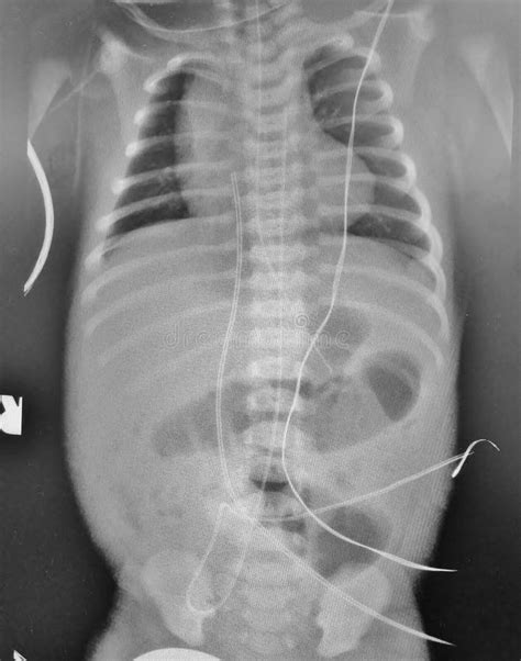 Umbilical Venous Catheter Radiology