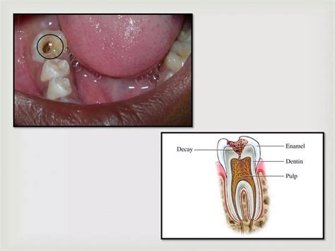 Pulpal Periapical Diseases Ppt