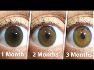 Recovery - Cataract surgery - EYE