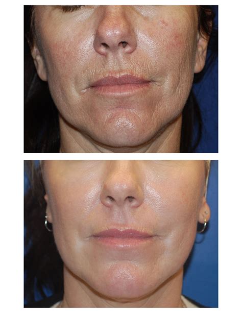 Erbium Laser Resurfacing All You Need To Know Artofit