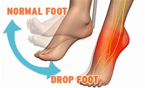 Foot Drop Drop Foot Syndrome