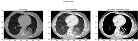 Figure 5 From Lung Nodule Classification Using Mobilenet Transfer