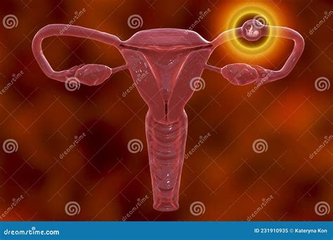 Ectopic Pregnancy Concept Infographics Illustration On Isolated