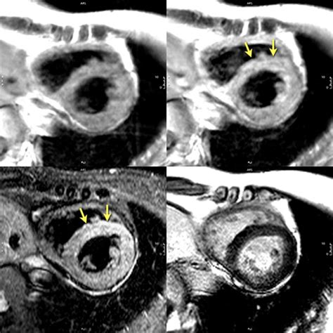 Cardiac Magnetic Resonance Assessment Of Myocarditis Circulation Cardiovascular Imaging