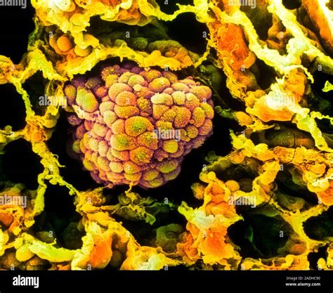 Lung Cancer Coloured Scanning Electron Micro Graph Sem Of A Small