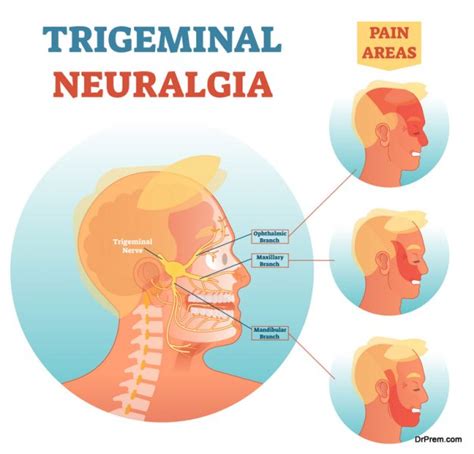 Trigeminal Neuralgia: Symptoms, diagnosis, and treatment