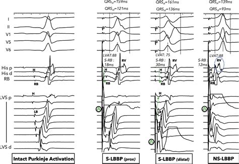 Influence Of Capture Selectivity And Left Intrahisian Block On Qrs