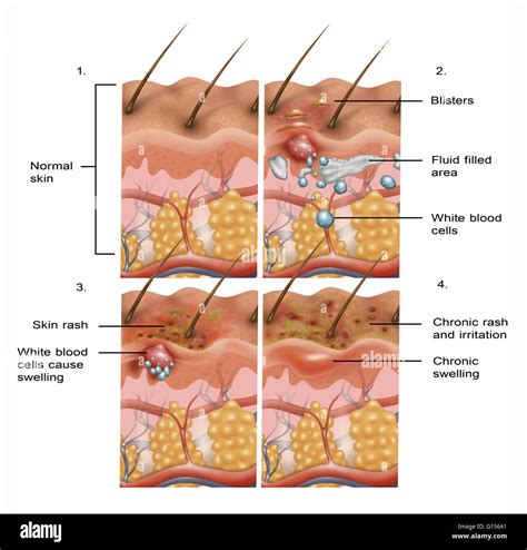 Cross Section Illustration De La Formation Deczéma Sur La Peau En