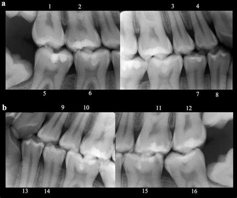 Taking Bitewing Dental X Rays