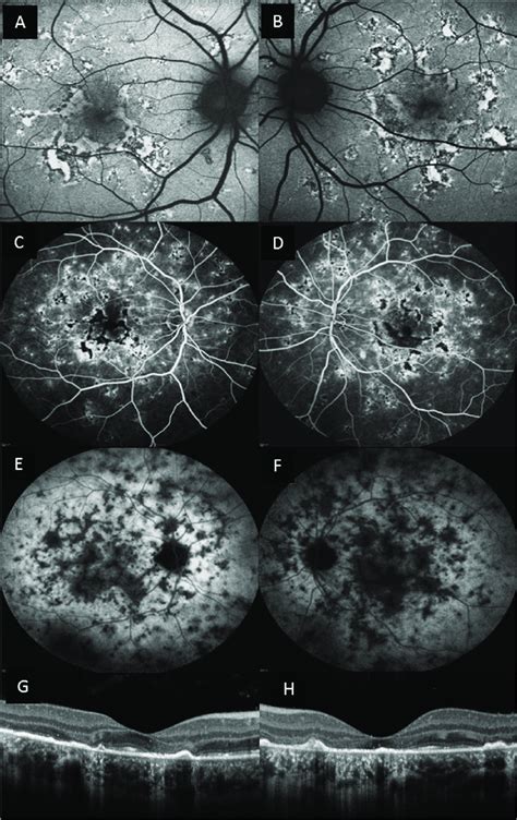 Multimodal Imaging Of Patient No Both Right And Left Eyes Are