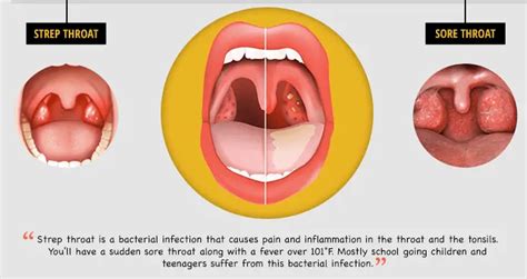 Sinus Drainage Causing Severe Sore Throat - Best Drain Photos Primagem.Org